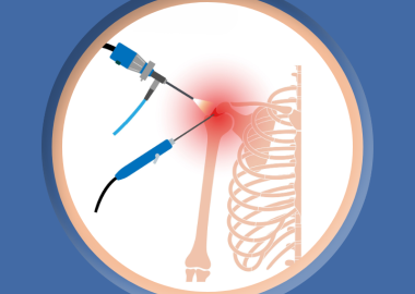 Artroskopia barku i rehabilitacja po zabiegu w Fizjo-Kinetic