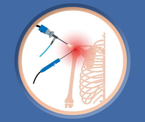 Artroskopia barku i rehabilitacja po zabiegu w Fizjo-Kinetic