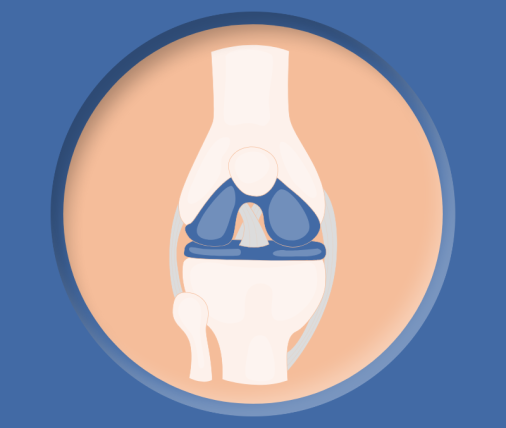 meniscektomia-lakotki-fizjokinetic-com