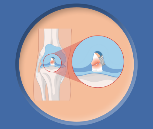 rekonstrukcja-acl-pcl-fizjokinetic-com
